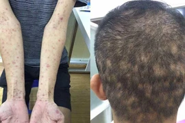 Bệnh giang mai tăng nhanh, có thể tổn thương tim, gan và tử vong