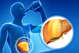 Dấu hiệu cảnh báo gan nhiễm mỡ nặng, nhanh chóng đi khám ngay còn kịp