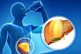 Dấu hiệu cảnh báo gan nhiễm mỡ nặng, nhanh chóng đi khám ngay còn kịp