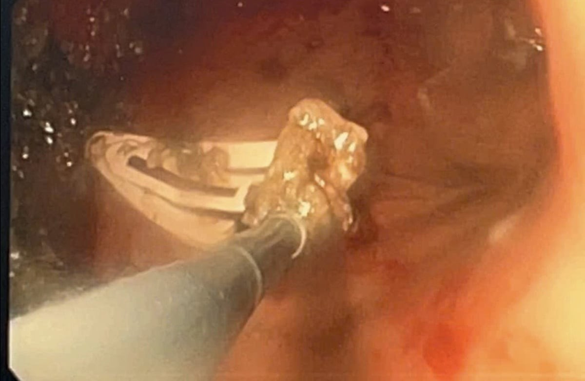 Dị vật trong dạ dày bé gái 6 tuổi. Ảnh BV