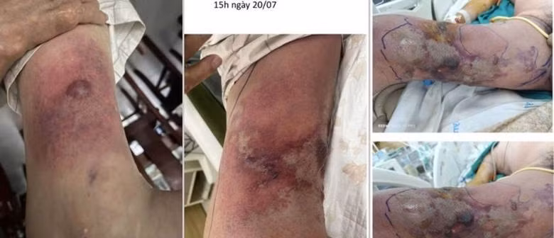 Tổn thương lan nhanh chóng từ một vết đốt nhỏ/ Ảnh moh.gov.vn