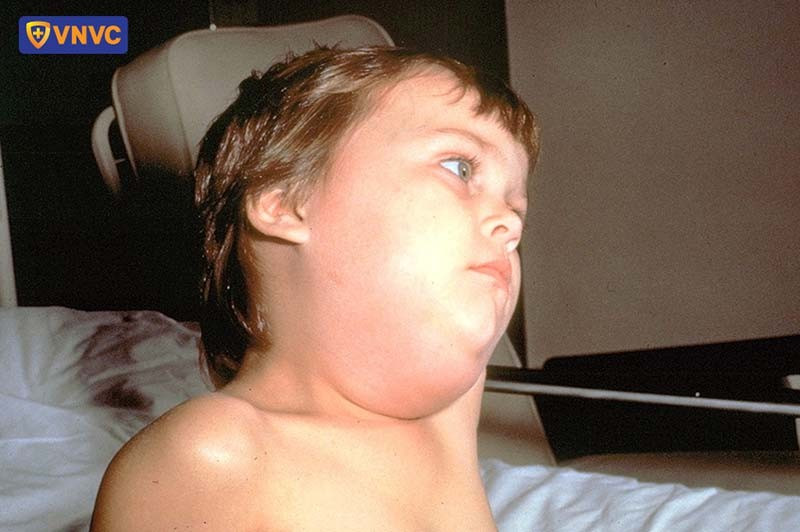 Hình ảnh cho thấy tuyến nước bọt (tuyến mang tai) ở trẻ mắc bệnh quai bị sưng đau và nhức làm ảnh hưởng đến sinh hoạt và chất lượng cuộc sống của trẻ/Ảnh VNVC