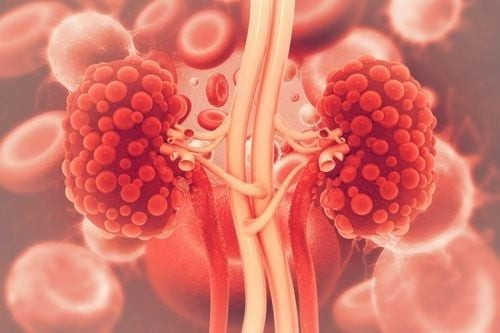 Suy thận là biến chứng sỏi thận/Ảnh vinmec.vn