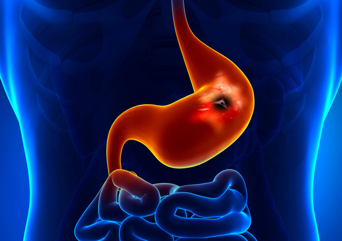 Viêm loét dạ dày là một trong những bệnh đường tiêu hóa có nhiều người mắc. Ảnh minh họa/Internet