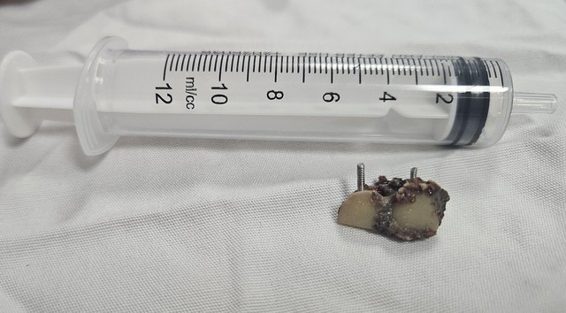 Một trong hai chiếc răng giả sau khi được lấy ra từ lòng phế quản bệnh nhân. Ảnh BV/nguồn SKĐS