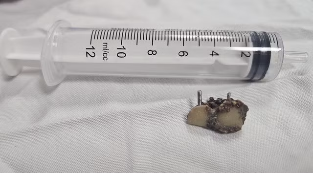 Một trong hai chiếc răng giả sau khi được lấy ra từ lòng phế quản bệnh nhân. Ảnh BV/nguồn SKĐS