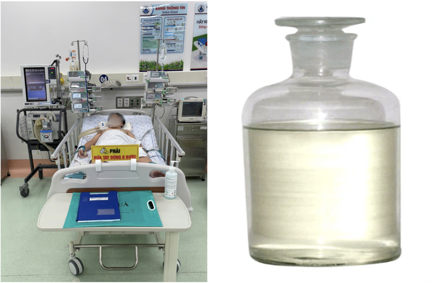 Bé trai khoẻ mạnh đột ngột hôn mê, suy hô hấp do hít phải hóa chất người cha mua dùng để hàn nhựa. Ảnh: BVCC