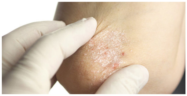 Cách tự nhiên giảm vảy nến hiệu quả trong mùa đông ảnh 1