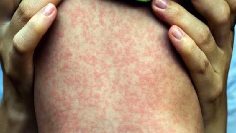 Cách phòng ngừa hiệu quả nhất là tiêm vắc-xin sởi, và điều trị chủ yếu là chăm sóc triệu chứng (hạ sốt, giảm ho, bổ sung nước, dinh dưỡng). Ảnh minh họa/Internet