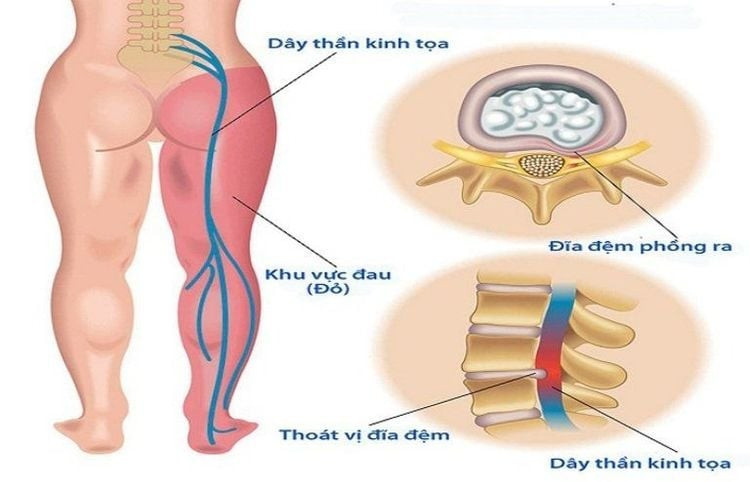 Vị trí dây thần kinh tọa/ Ảnh vinmec.com