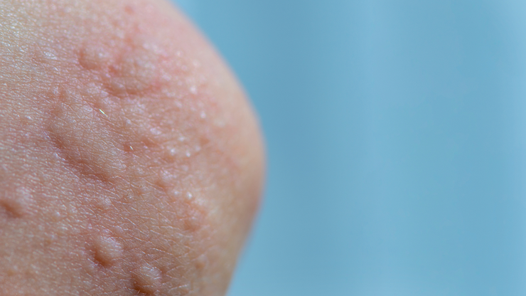 Vùng da nổi mày đay do lạnh. Ảnh minh họa/Internet