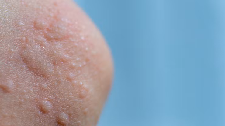 Vùng da nổi mày đay do lạnh. Ảnh minh họa/Internet