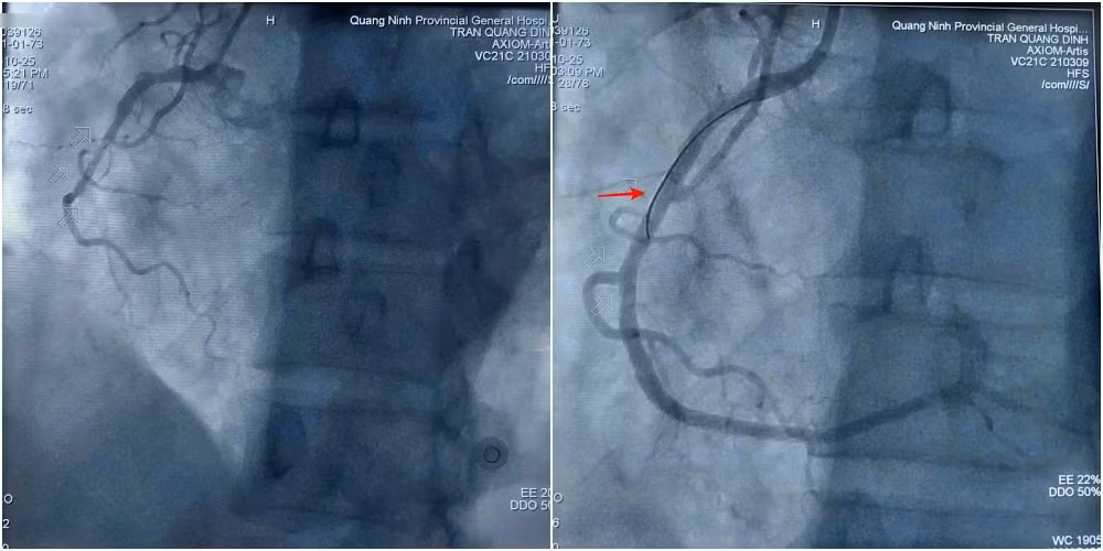 Hình ảnh trước và sau can thiệp đặt stent tái thông mạch vành cho bệnh nhân Q. Ảnh BV
