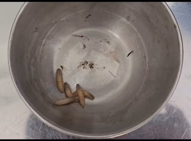 5 con giòi trong tai bà T. đã được các bác sĩ lấy ra thành công. Ảnh BV