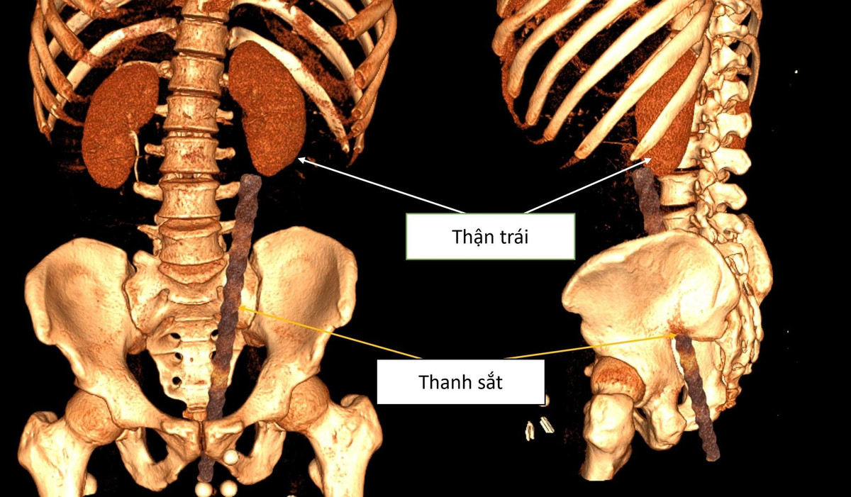 Hình ảnh dị vật xuyên qua lỗ hậu môn với độ sâu khoảng 30cm.