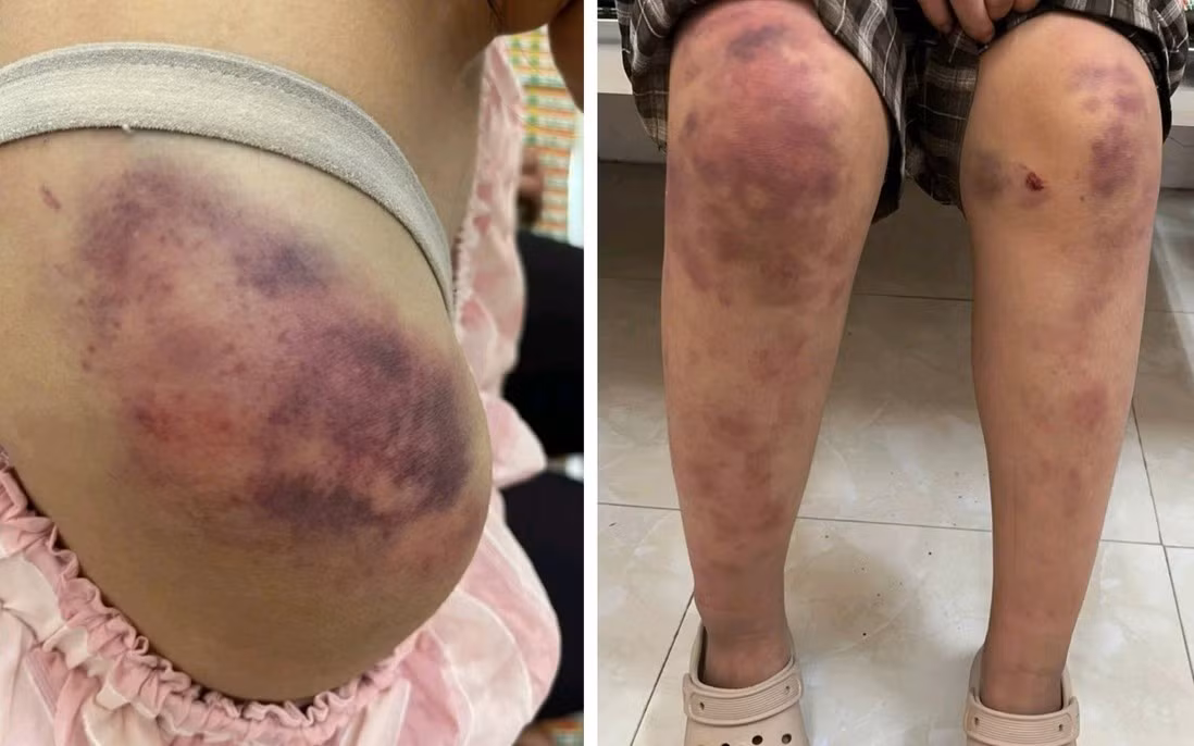 Những vết bầm tím trên cơ thể cháu P.A. do bị đánh/Ảnh PNVN