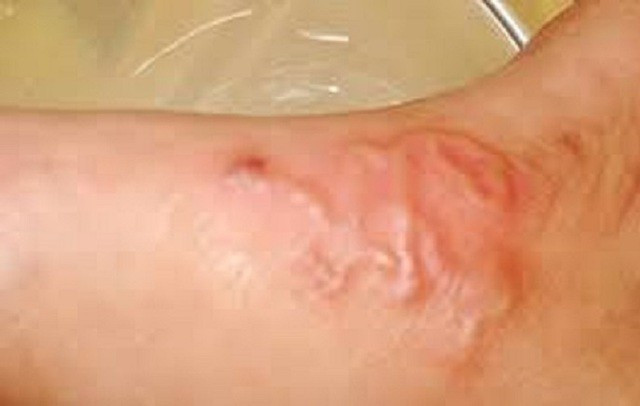 Khi có các triệu chứng nghi ngờ mắc bệnh sán chó, như ngứa ngáy ở nhiều vị trí trên cơ thể, người dân nên đến cơ sở y tế để được khám và tư vấn điều trị. Nhiễm sán chó gây ngứa, nổi mề đay kéo dài.