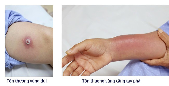 Sau cấy chỉ giảm đau xương khớp 2 ngày, cẳng tay phải người bệnh sưng nề, các ngón tay khó cử động, vùng đùi xuất hiện vết thương sưng tấy, có mủ. Ảnh BV