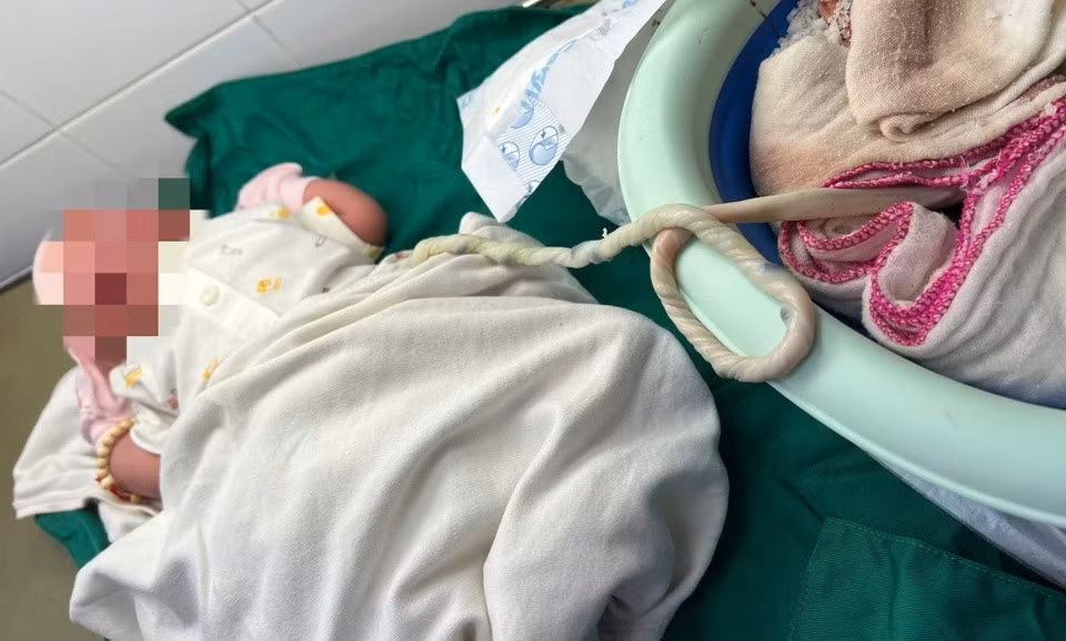 Trẻ nhập viện trong tình trạng còn nguyên bánh nhau. Ảnh: TTYT Cẩm Mỹ.
