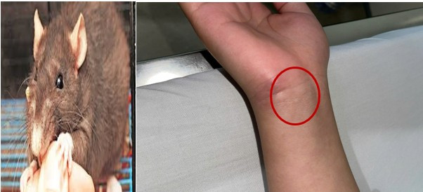 Vết chuột cắn tại cổ tay của người bệnh nhiễm Sodoku/Ảnh Bệnh viện TWQĐ 108