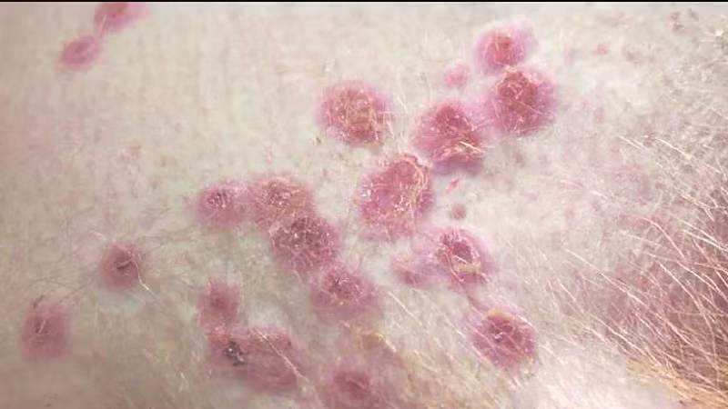Tổn thương da do bệnh đậu mùa khỉ gây ra. Ảnh Tạp chí Khoa học Thú y