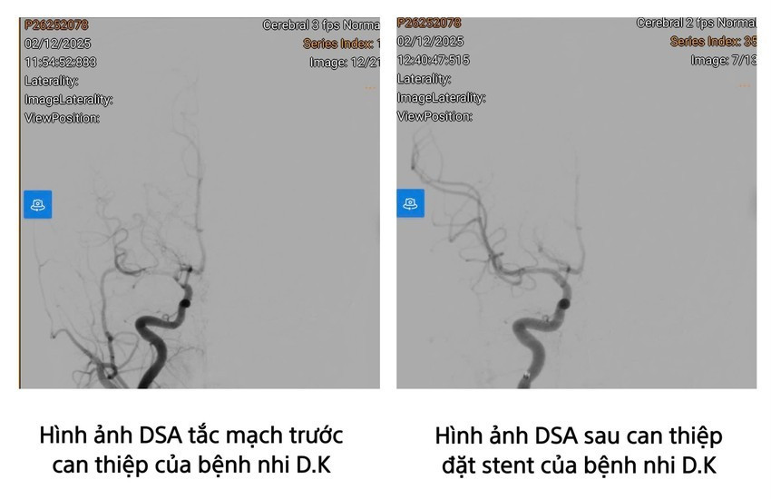 Hình ảnh chụp mạch máu số hóa xóa nền (DSA) của bệnh nhi ĐK. Ảnh BV