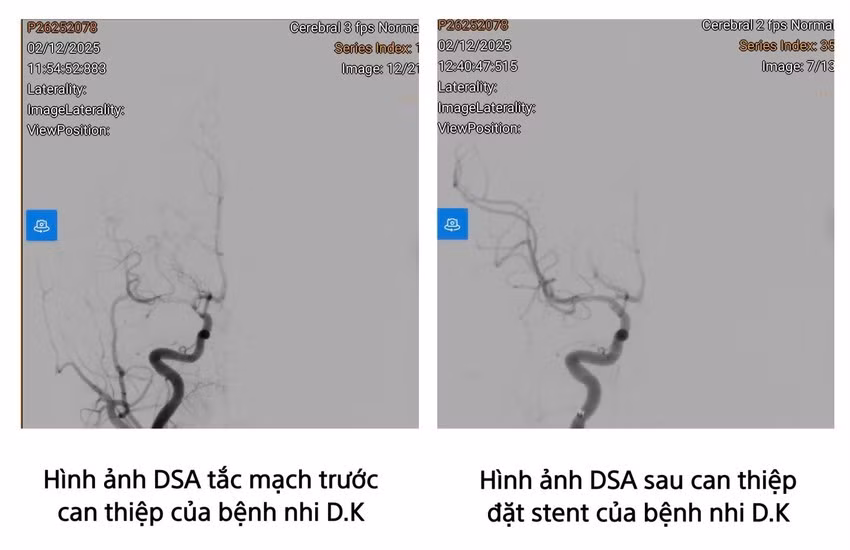 Hình ảnh chụp mạch máu số hóa xóa nền (DSA) của bệnh nhi ĐK. Ảnh BV
