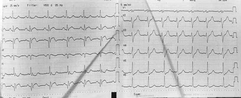 Nhịp tim bất thường trên điện tâm đồ của bệnh nhân Q. sau phẫu thuật. Ảnh BV