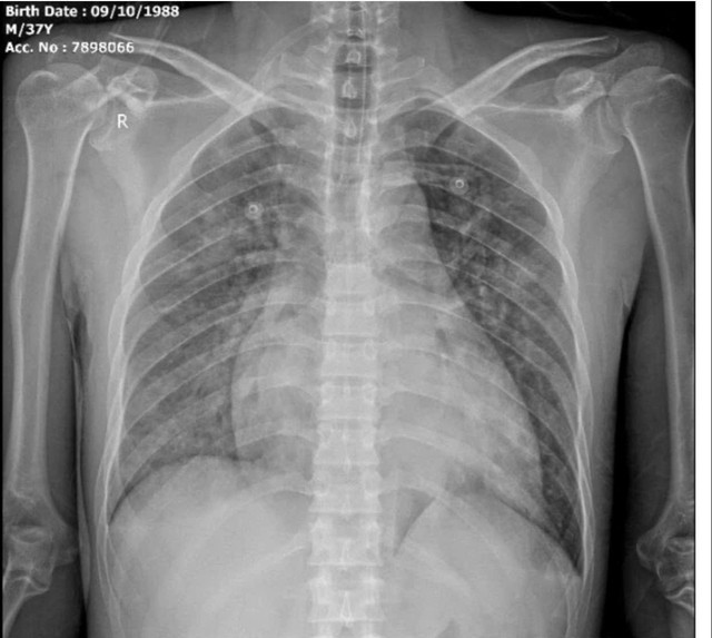 Cấp cứu thành công ca tăng kali máu nguy kịch, nguy cơ ngừng tim. Ảnh SKĐS