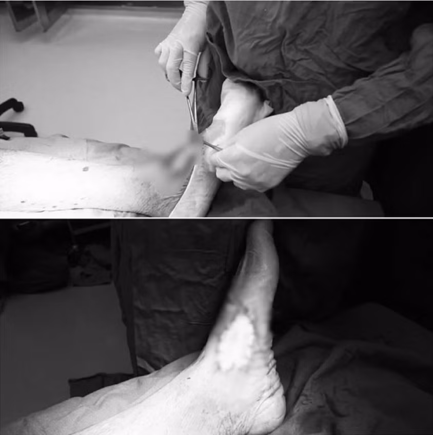 Để hạn chế tổn thương lan rộng, các bác sĩ đã quyết định can thiệp phẫu thuật ngay lập tức. Ảnh Bệnh viện Việt Nam – Thụy Điển Uông Bí