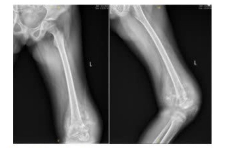 Hình ảnh X Quang lúc bệnh nhi mới nhập viện. Ảnh: BVCC