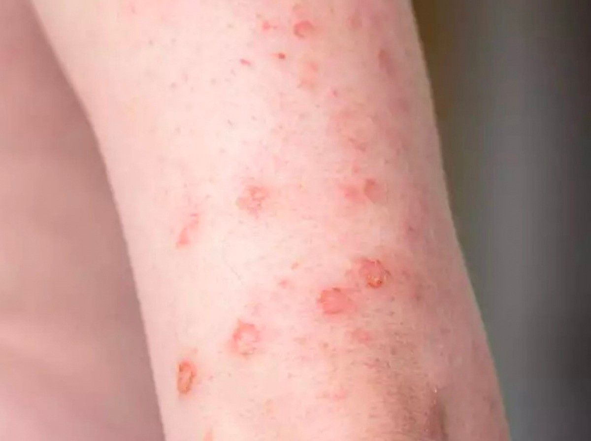 Triệu chứng khi bị giang mai. Ảnh minh họa/Nguồn Internet