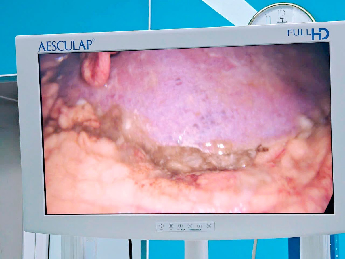 Bệnh nhân bị thủng tạng rỗng, sốc nhiễm khuẩn do lạm dụng thuốc giảm đau/Ảnh BV