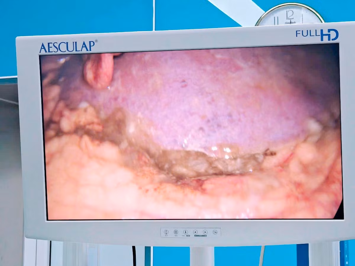 Bệnh nhân bị thủng tạng rỗng, sốc nhiễm khuẩn do lạm dụng thuốc giảm đau/Ảnh BV