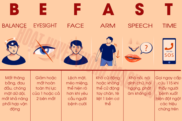 Dấu hiệu nhận biết nhanh đột quỵ theo quy tắc BEFAST. Ảnh minh hoạ/Nguồn Internet
