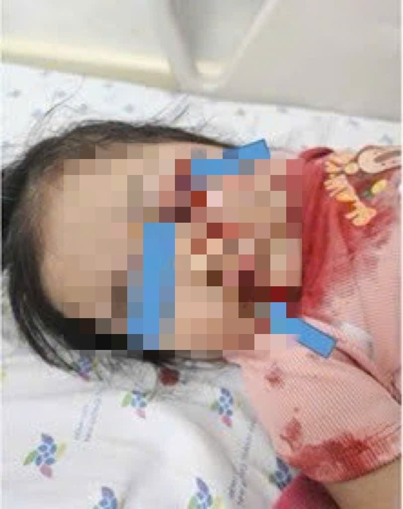 Bé H. C. T. 26 tháng tuổi, chẩn đoán: vết thương phức tạp vùng mắt trái, môi dưới phải, dập phổi trái, do tai nạn xe tay ga, được cấp cứu tích cực, sức khỏe cải thiện dần. Ảnh: Bệnh viện Nhi đồng Thành phố/Nguồn danviet