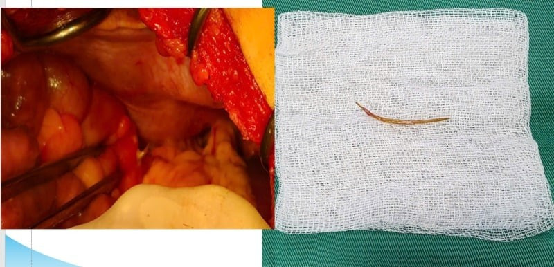 Hình ảnh dị vật xương cá đâm xuyên thành đại tràng bệnh nhân LBS. Ảnh BVCC