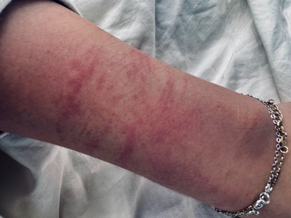 Tay của nữ bệnh nhân bị bầm đỏ vì bị Chiến khống chế.