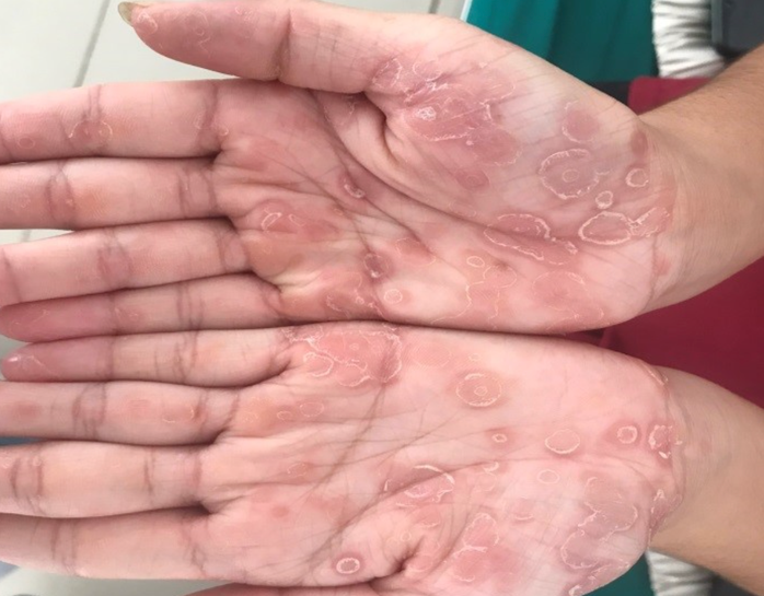 Ban đỏ ở lòng bàn tay là một trong những dấu hiệu của bệnh giang mai. Ảnh minh họa/NLĐ