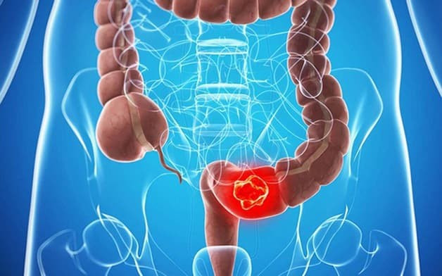 Các bệnh lý đại tràng nói chung và đại tràng sigma nói riêng thường gây ảnh hưởng nhiều đến cuộc sống của người bệnh. Ảnh minh họa/benhvienthucuc.vn