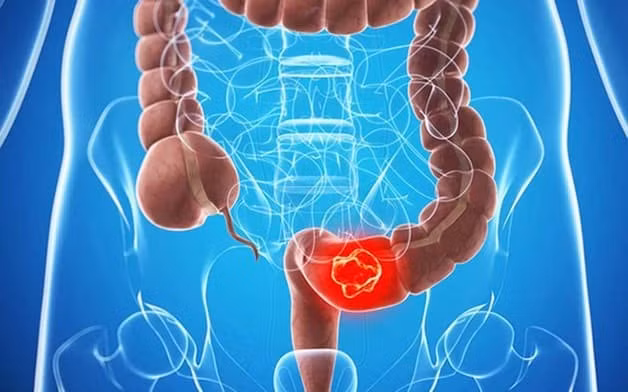 Các bệnh lý đại tràng nói chung và đại tràng sigma nói riêng thường gây ảnh hưởng nhiều đến cuộc sống của người bệnh. Ảnh minh họa/benhvienthucuc.vn