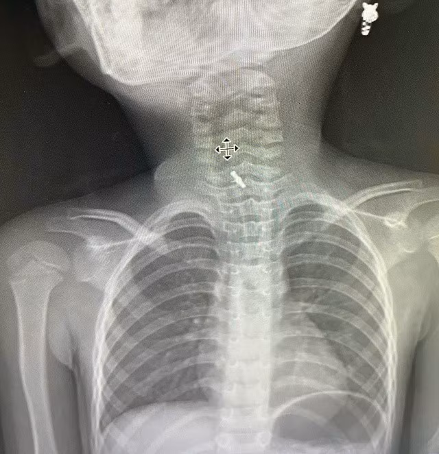 Hình ảnh chụp X-Quang xác định dị vật mắc tại thực quản. Ảnh BV