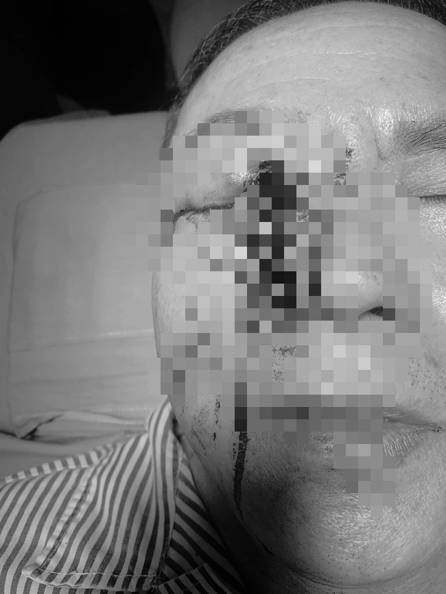 Dị vật kim loại cắm xuyên qua hốc mắt, đe dọa trực tiếp đến cấu trúc nhãn cầu và nguy cơ mất thị lực hoàn toàn của người bệnh. Ảnh: BVCC/SKĐS