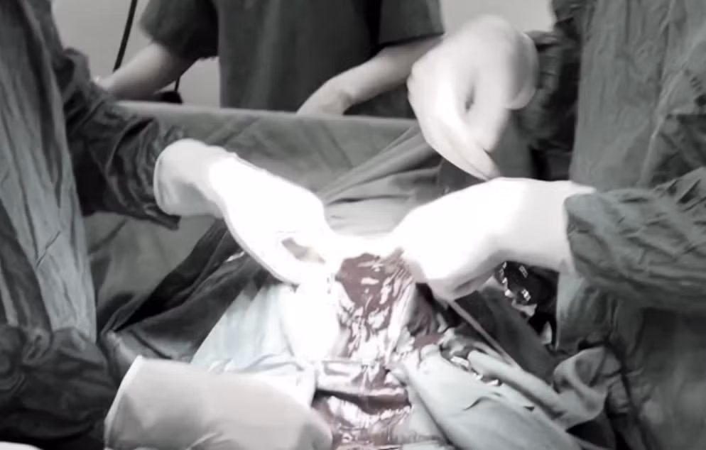 Ê-kíp phẫu thuật buộc phải cắt tử cung bán phần để cứu sống bệnh nhân. Ảnh PLXH.