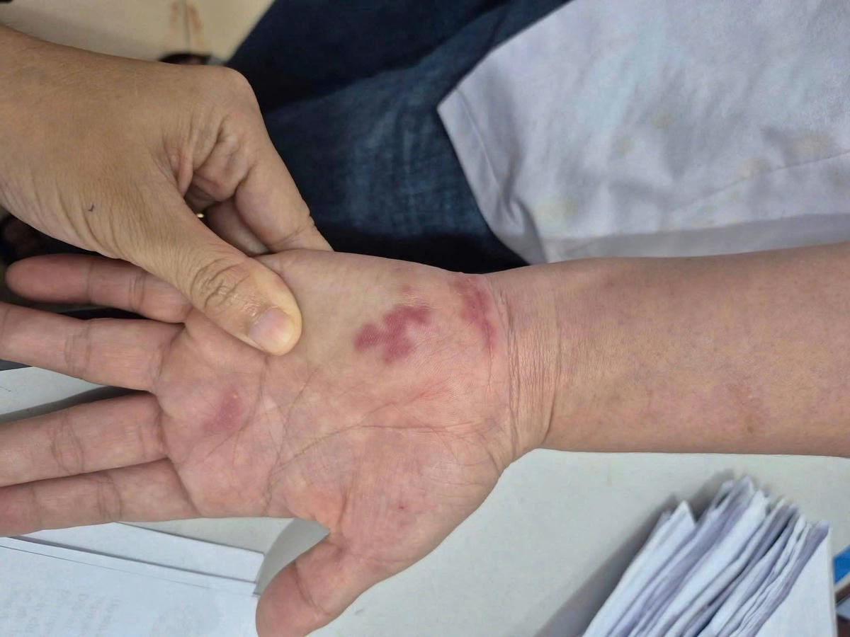 Cụ ông 70 tuổi nhiễm vi khuẩn 'ăn thịt người' sau khi bị vây cá đâm