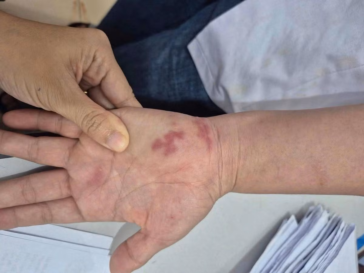 Cụ ông 70 tuổi nhiễm vi khuẩn 'ăn thịt người' sau khi bị vây cá đâm