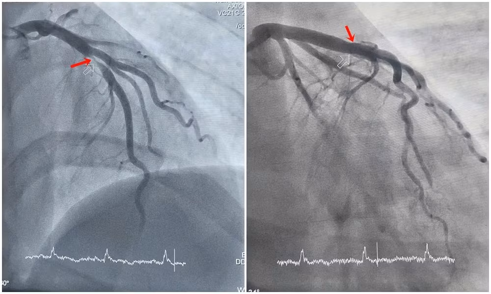Hình ảnh hẹp tắc động mạch liên thất trước của bệnh nhân H. được can thiệp tái thông. Ảnh BV