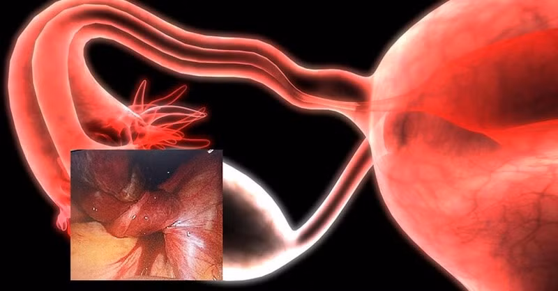 U nang buồng trứng xoắn là căn bệnh nguy hiểm mà chị em không thể chủ quan. Ảnh minh hoạ/Internet