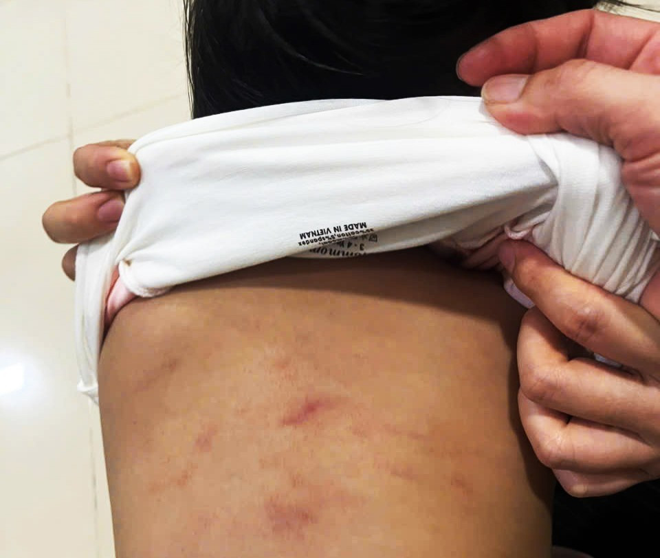 Vết bầm tím trên lưng bé N. (2 tuổi) nghi do bị bạo hành.