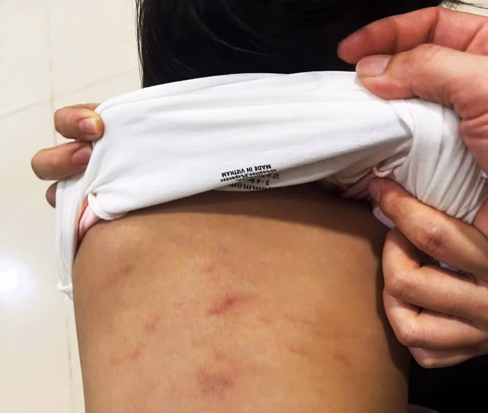 Vết bầm tím trên lưng bé N. (2 tuổi) nghi do bị bạo hành.